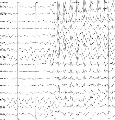 Different types of brain waves